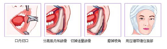  长曲线下颌角手术