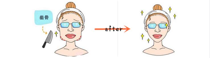  下颌角整形手术方法及适应症