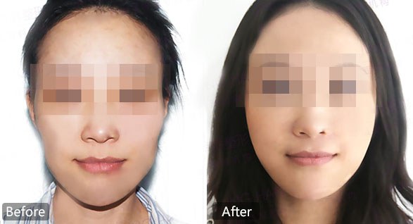  北京削骨瘦脸手术需要多少钱