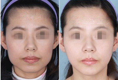  北京注射一次瘦脸针多少钱