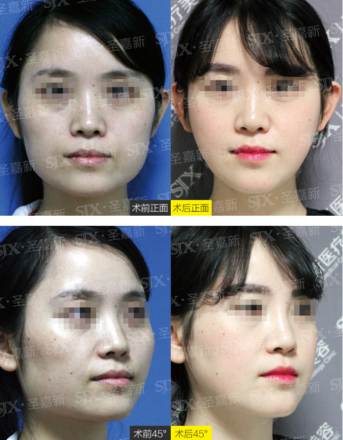  北京改脸型手术哪种好