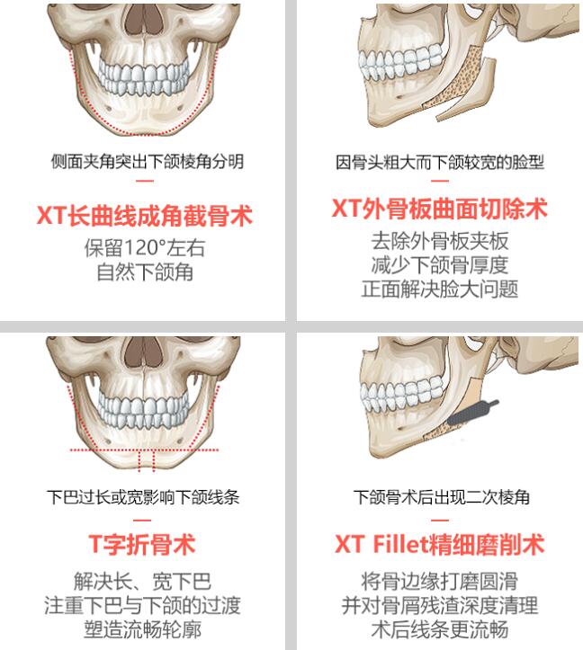  哪几种方法能做下颌角