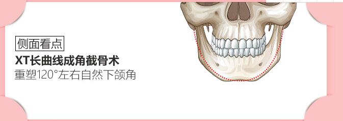  下颌角手术的方法有哪些