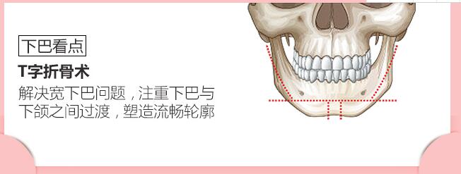  下颌角手术的方法有哪些