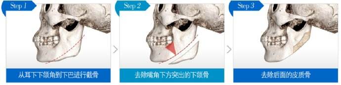  下颌角整形手术方法
