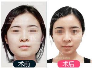  下改脸型手术的方法有哪些