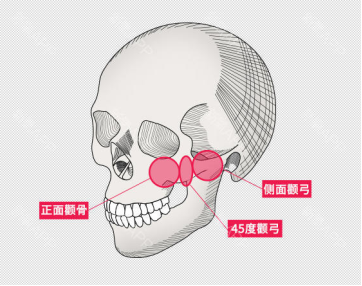  张笑天讲解颧骨颧弓术后下垂是什么原因