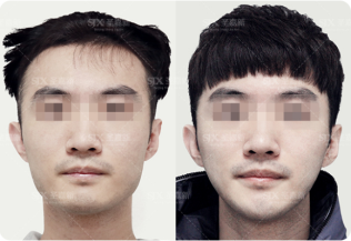  CCTV专访张笑天：改脸型哪种手术更合适