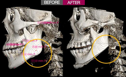  下颌角CT对比图