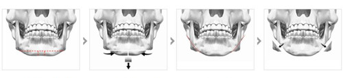  T型截骨-下颌角整形