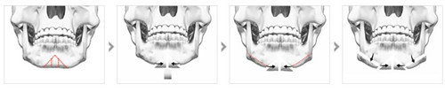  人字型截骨-下颌角整形